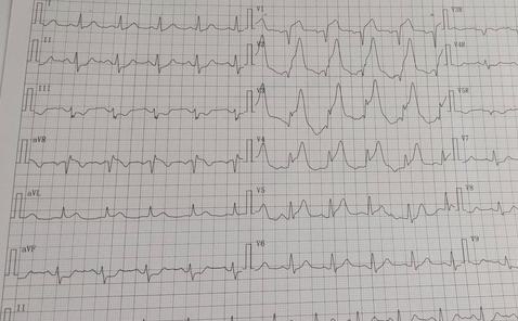 急性心梗的病人发生心脏骤停,急性心梗溶栓快还是支架快
