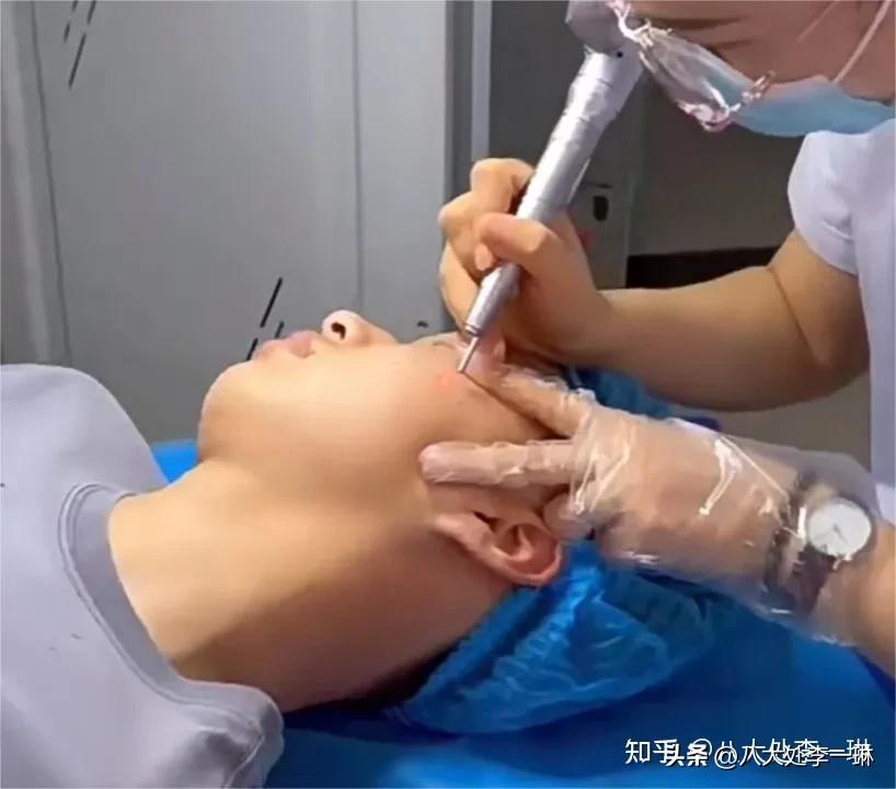 什么是色素痣,色素痣的形成原因及去除方法