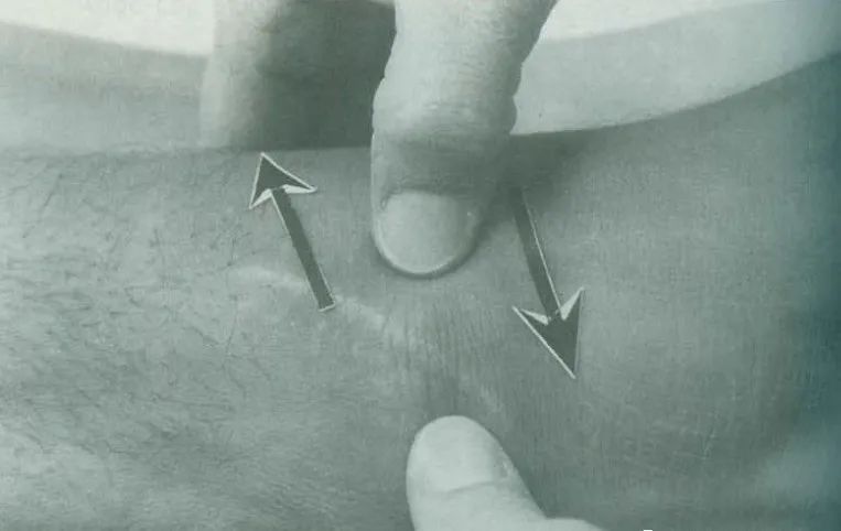 瘢痕松解术操作手法,瘢痕松解法