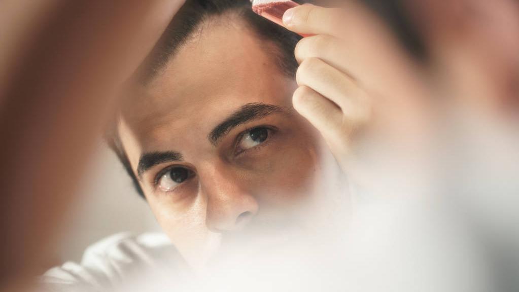 26岁脱发特别厉害秃了怎么办,26岁小伙脱发的烦恼