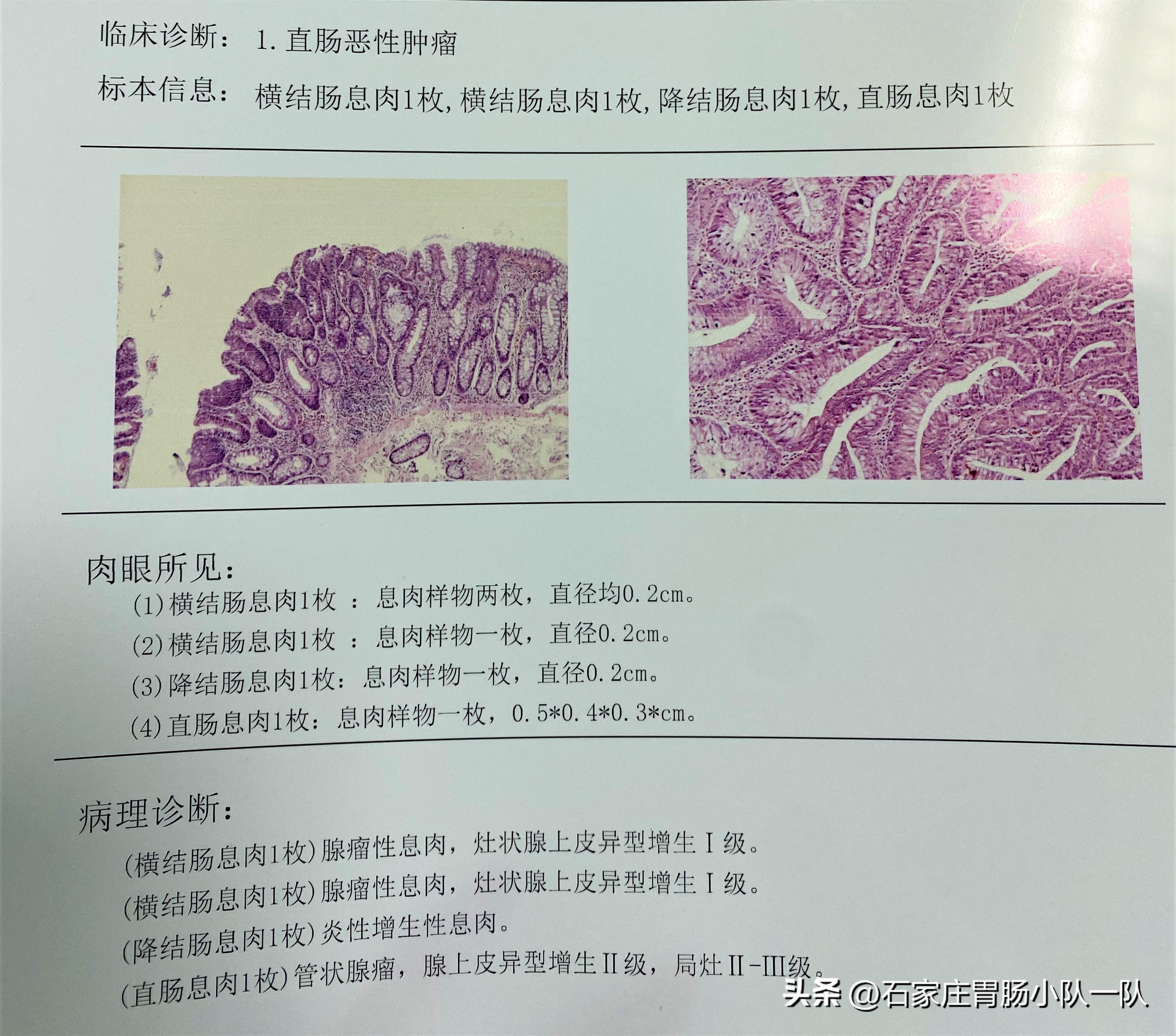 结直肠息肉的分类有哪些,结直肠息肉多大比较严重