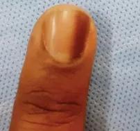 指甲出现黑线是什么病,指甲出现黑线怎么治疗