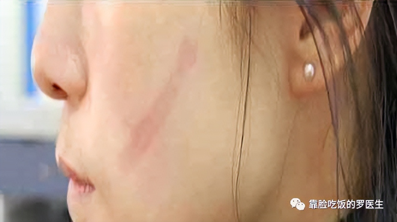 科普疤痕知多少,瘢痕科普视频