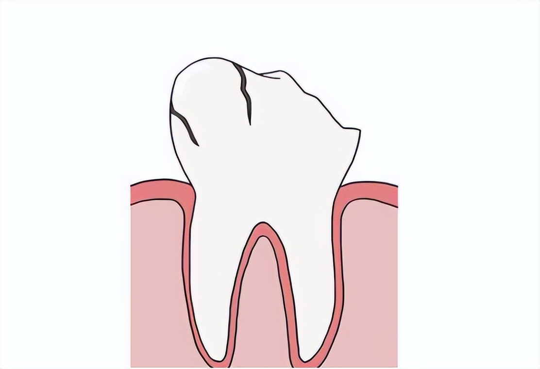 牙根纵裂怎么治疗最好,牙根病变的最好治疗方案