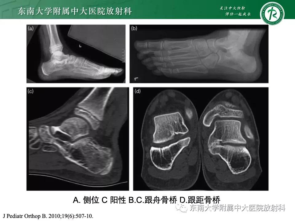好文分享-《肌骨系统疾病——副舟骨综合征》