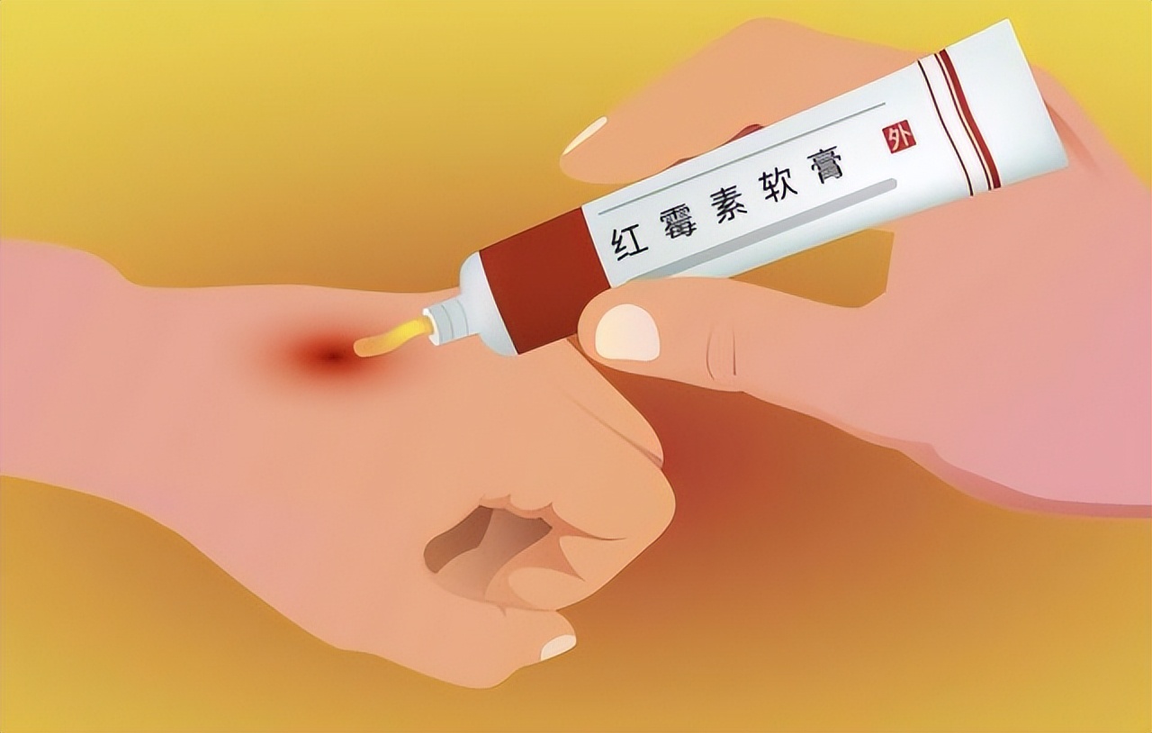 红霉素软膏真的可以去除老人斑吗,红霉素软膏能否去除老年斑