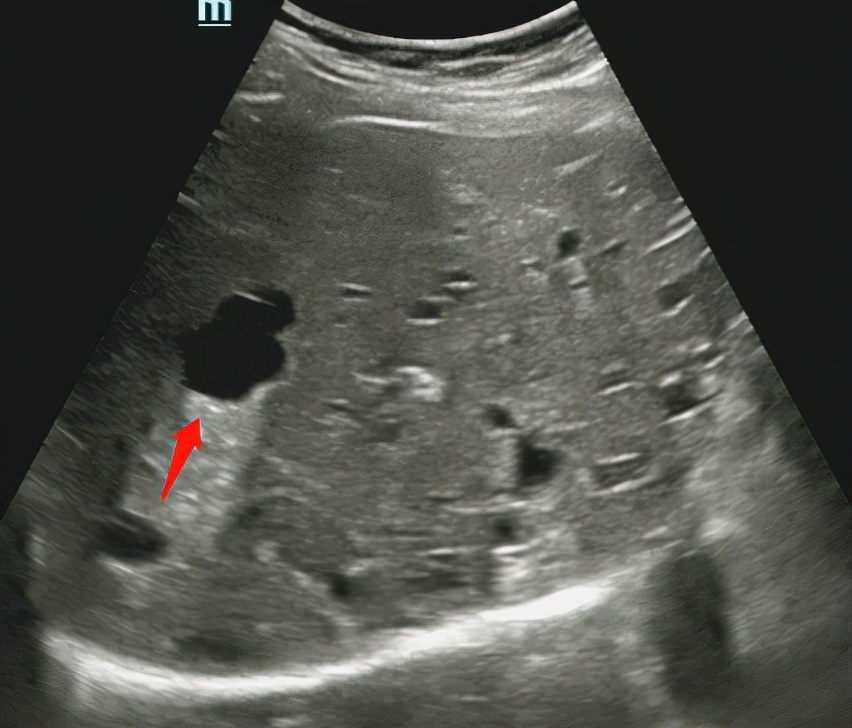 腹部彩超能查出什么病,腹部彩超能查出什么癌症吗