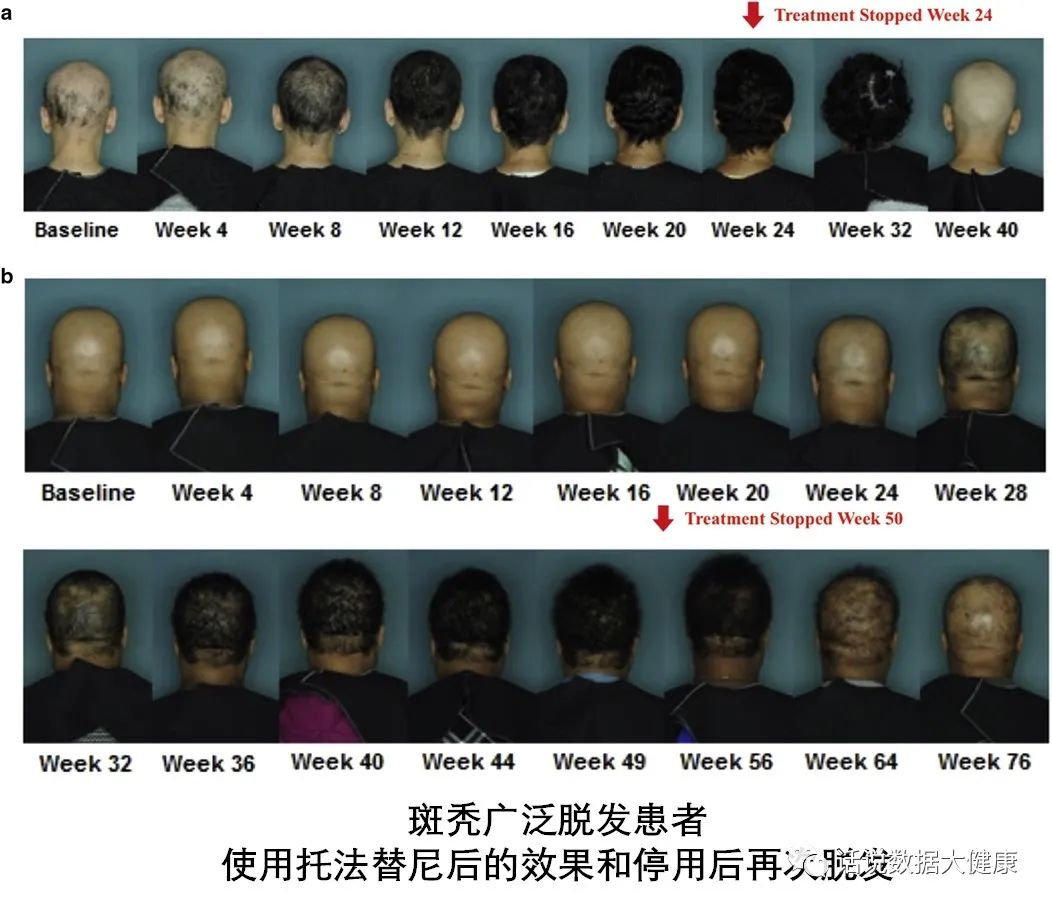 首个获批治疗严重脱发的药物，服用后就像脱发从未发生一样？