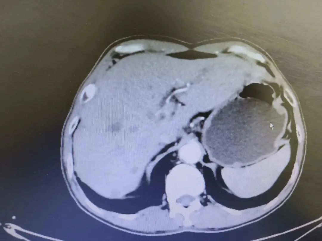 胃癌晚期化疗的全过程视频,化疗过程视频完整版胃癌