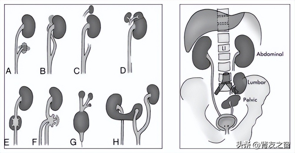 泌尿系统包括哪些器官？泌尿系统发育畸形有哪些？