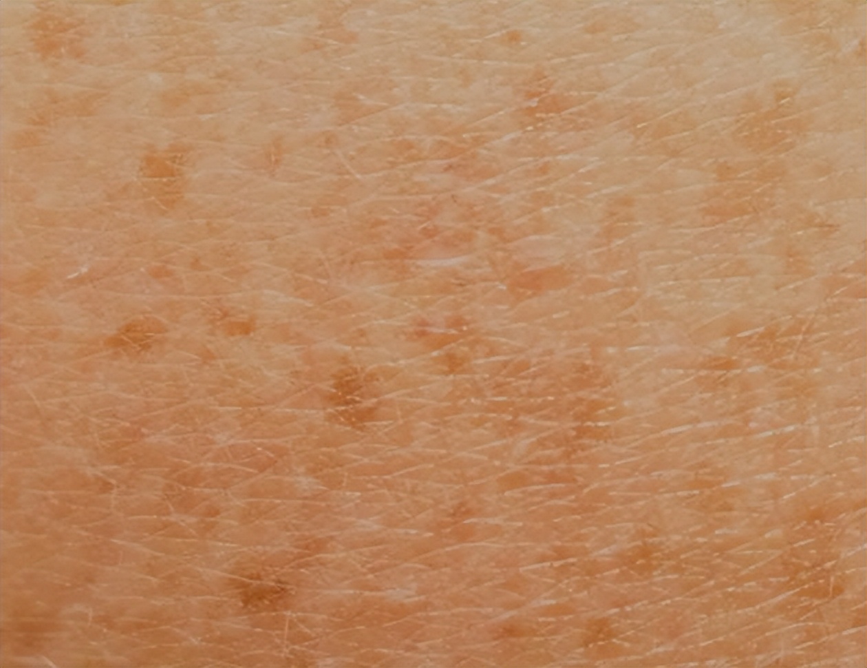 快速消除老年斑的小妙招红霉素,红霉素软膏能去除老年斑吗