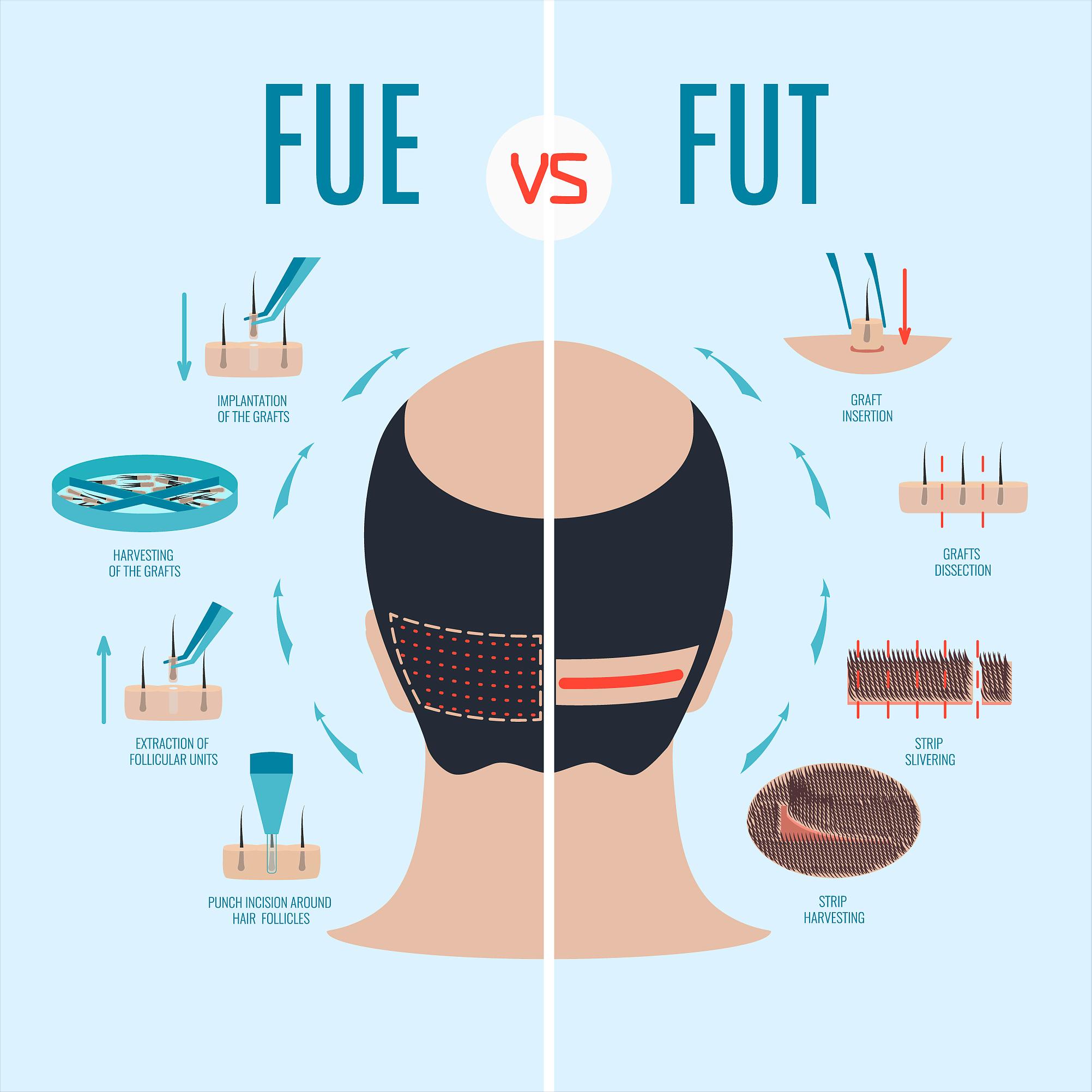 植发靠谱吗效果能保持多久,植发效果能维持多少年