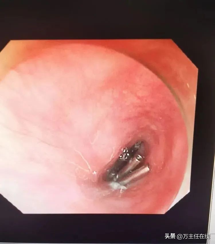 上海第一人民医院消化科万荣教授,消化内科专家手术