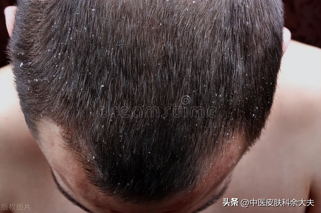 脱发是世界难题,脱发严重时不妨试试以下三招