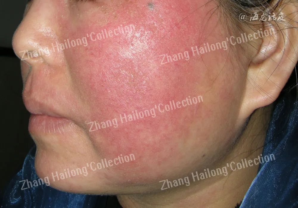 敏感皮肤发病因素再认识