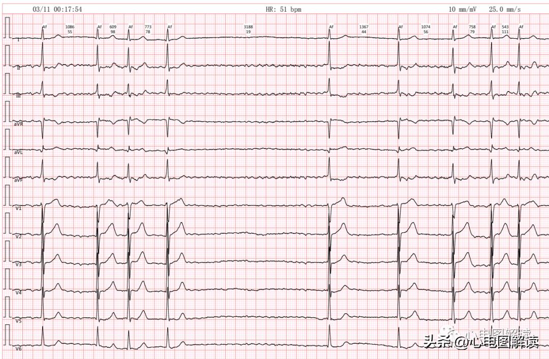 心房颤动伴长间歇心电图,心房颤动伴长间歇是什么意思