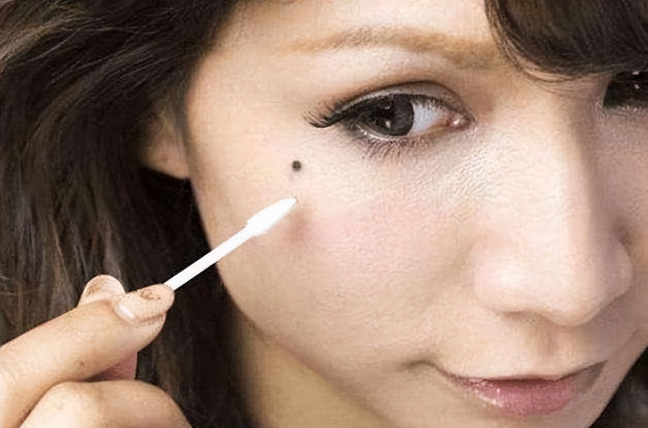 医生如何检查黑痣和黑色素瘤,医生长在摩擦部位的黑痣要当心