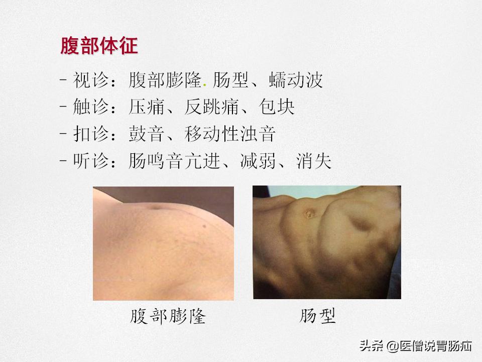 肠梗阻健康教育,肠梗阻患者的健康宣教