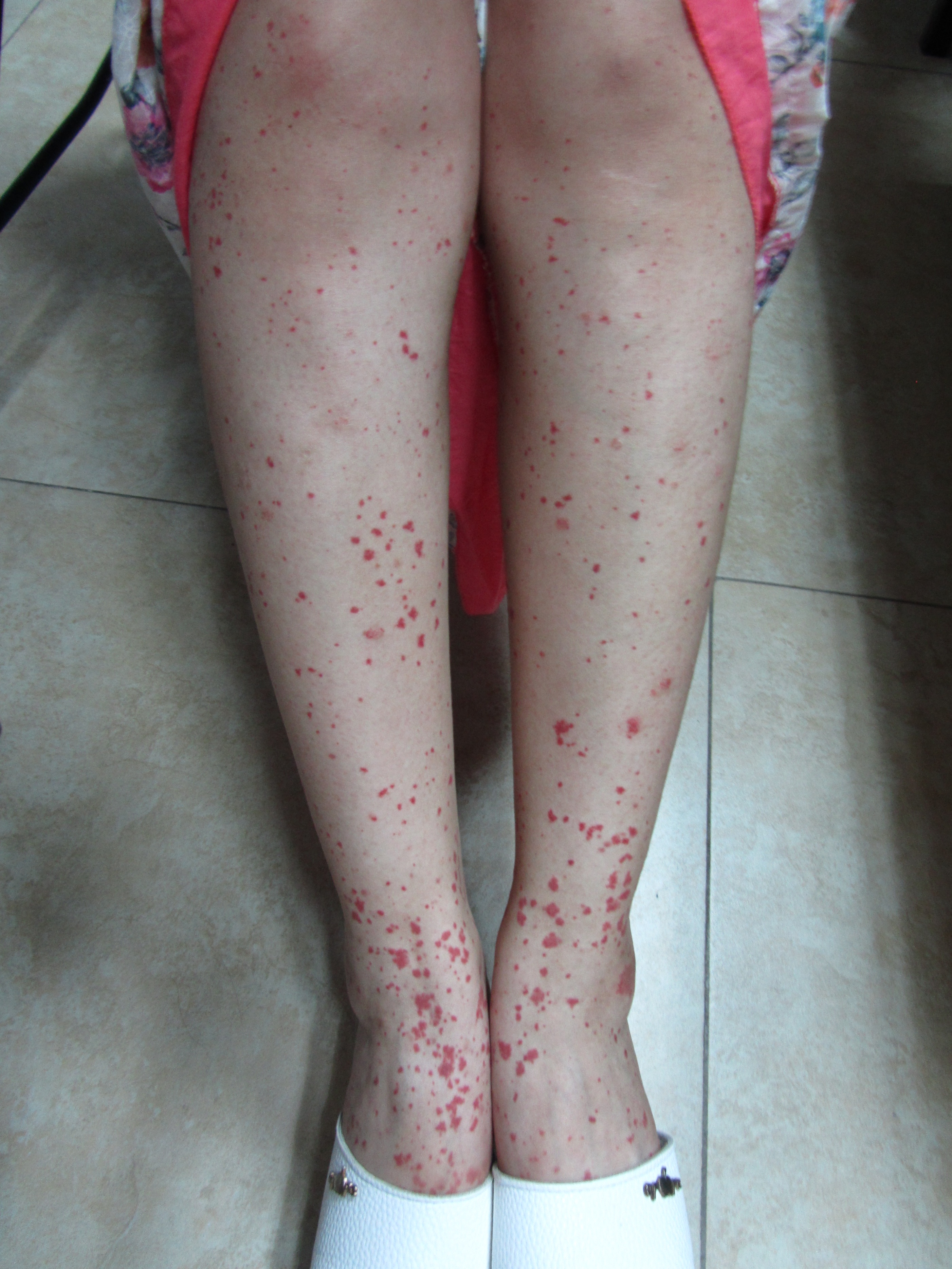 过敏性紫癜小腿反复出现出血点,过敏性紫癜老反复起小红点怎么办