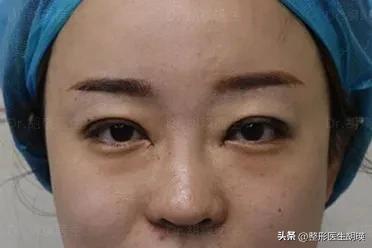 做双眼皮20天大小眼,做双眼皮二十几岁做最好