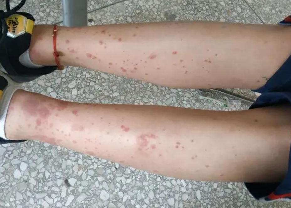 过敏性紫癜患者可以自愈吗,过敏性紫癜出现又自愈怎么回事