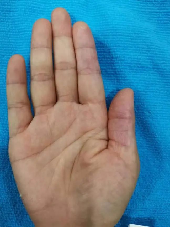 只需2步搞定宝宝湿疹,0-1岁祛湿疹的药