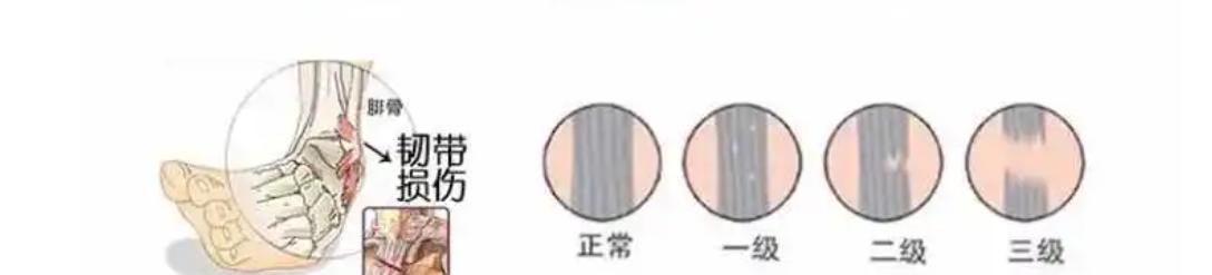 踝关节急性扭伤先冷敷还是热敷,扭伤踝关节应该热敷还是冷敷