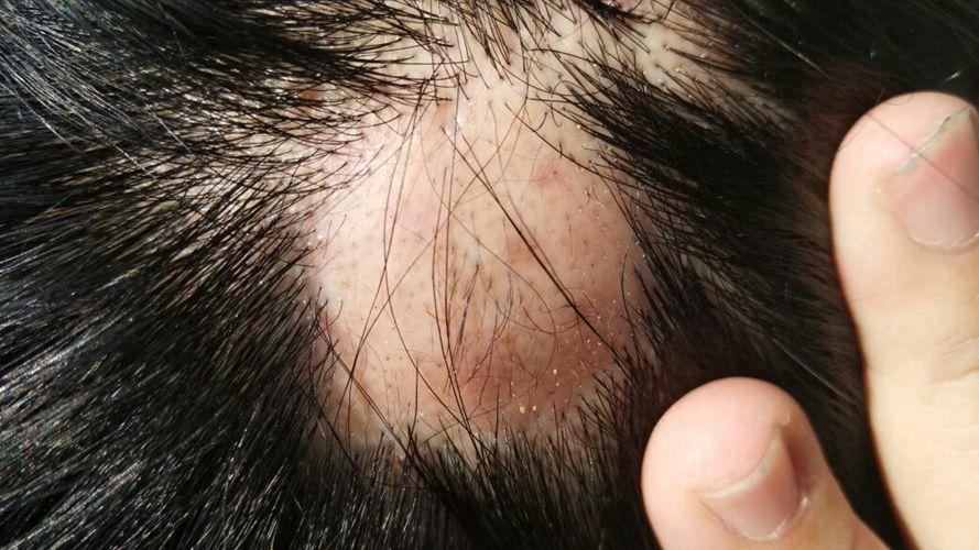 为什么头皮上有小疙瘩和脓包,头皮长疙瘩和脓包是怎么回事