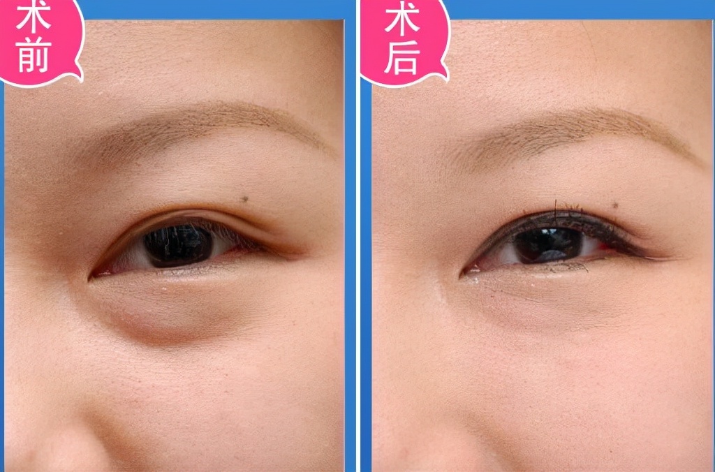 眼袋大怎么办如何解决快又好,眼袋大很显老小妙招