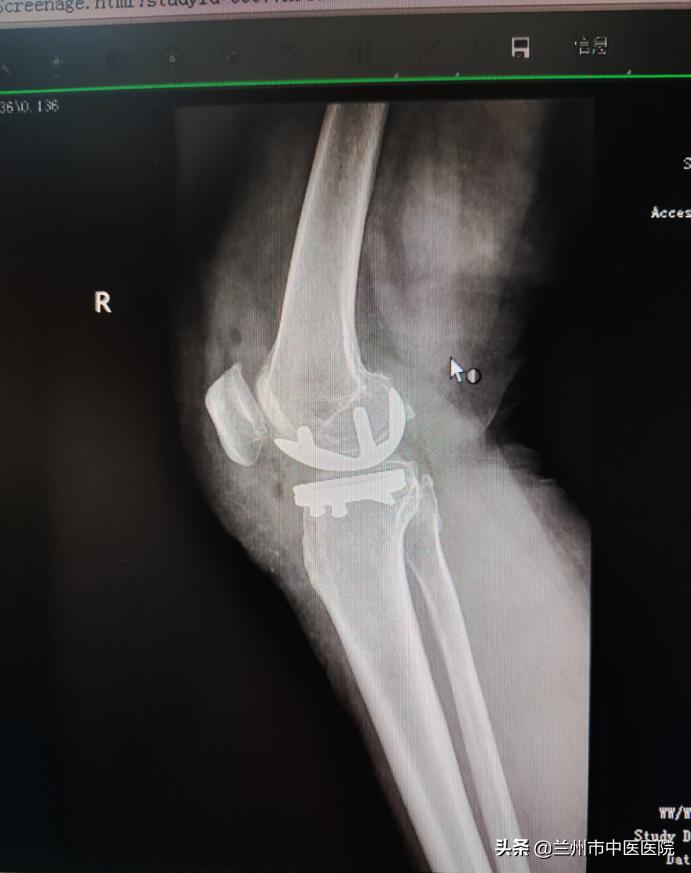 兰州市中医骨伤科医院,兰州中医骨伤科医院康复科