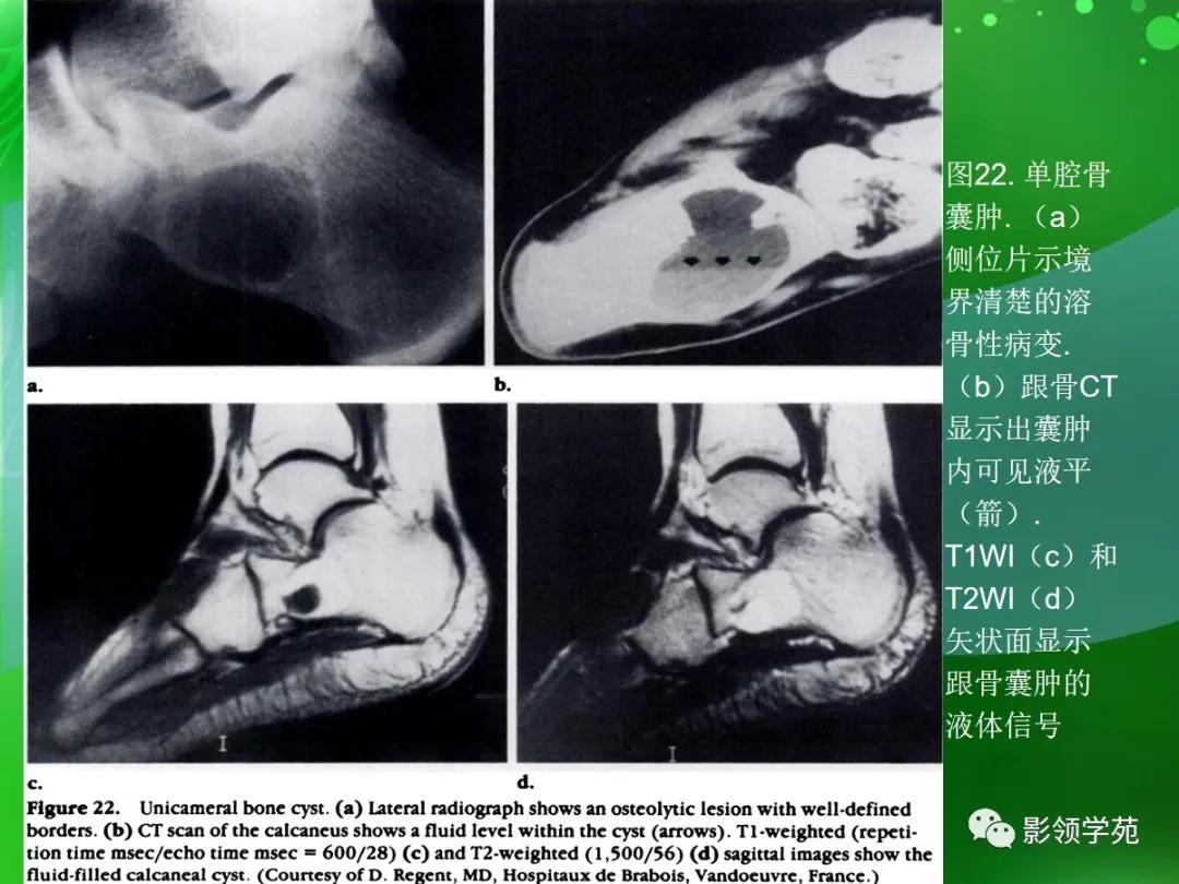 正常跟骨影像图,跟骨正常与变异影像表现图片