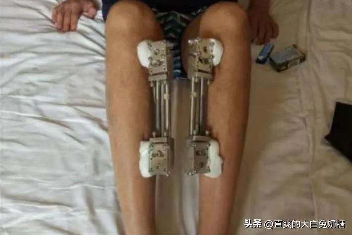 李亚诺断骨增高怎样了,断骨增高手术的李亚诺现状