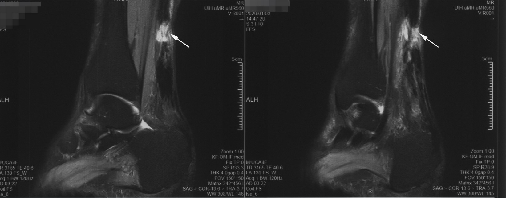 #非常病例#跳广场舞导致跟腱断裂，微创修补重返舞台
