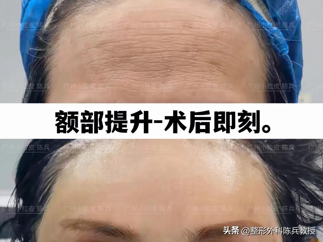 抗衰大拉皮,拉皮作为面部抗衰项目要注意哪些