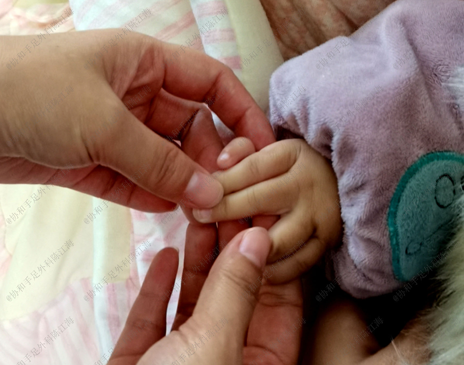 宝宝漂浮拇，被建议“一刀切”做示指拇化，我该怎么办？