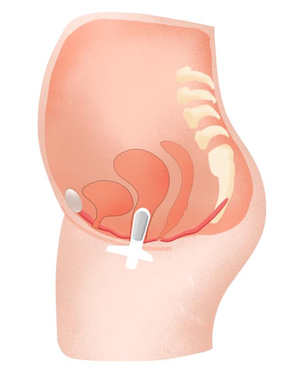 吃好休息好也不能让受损的盆底肌自愈！