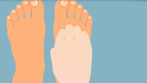 夏天脚气发作脚痒难忍用什么药膏,脚气痒脱皮有小水泡治疗小妙招