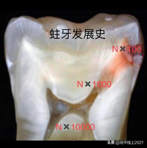 关于根管治疗的各种情况,根管治疗你不知道的秘密