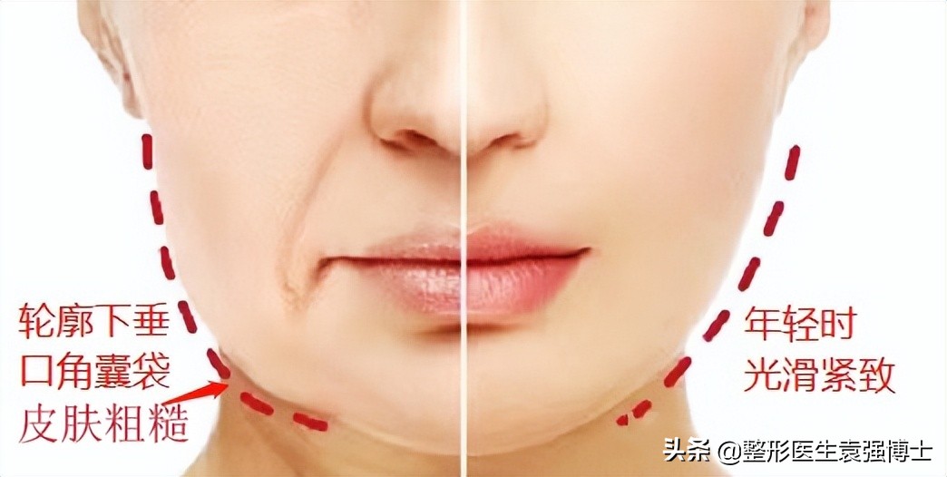 45岁脸垮有什么办法,四十岁怎样防止脸部发腮