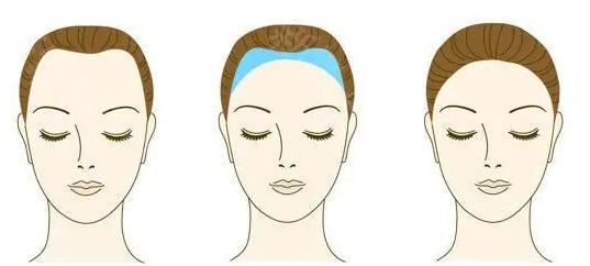 24岁脱发很严重发际线后移5厘米,本地25-55岁脱发者秃顶发际线后移