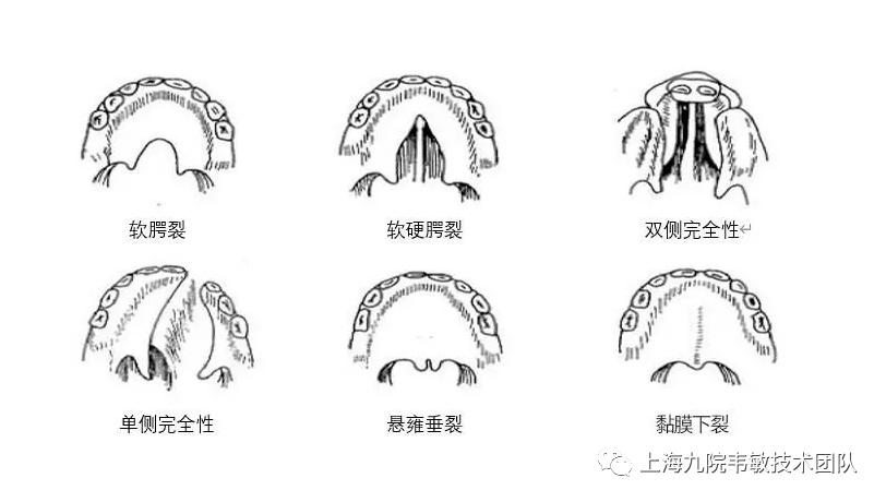 韦敏唇腭裂,上海九院哪个医生做唇腭裂比较好