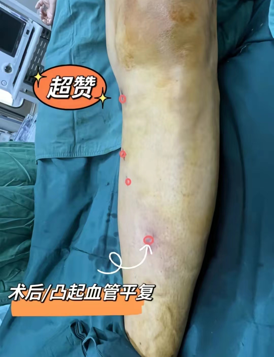 下肢静脉曲张要怎么治疗效果明显,求治疗静脉曲张的好方法