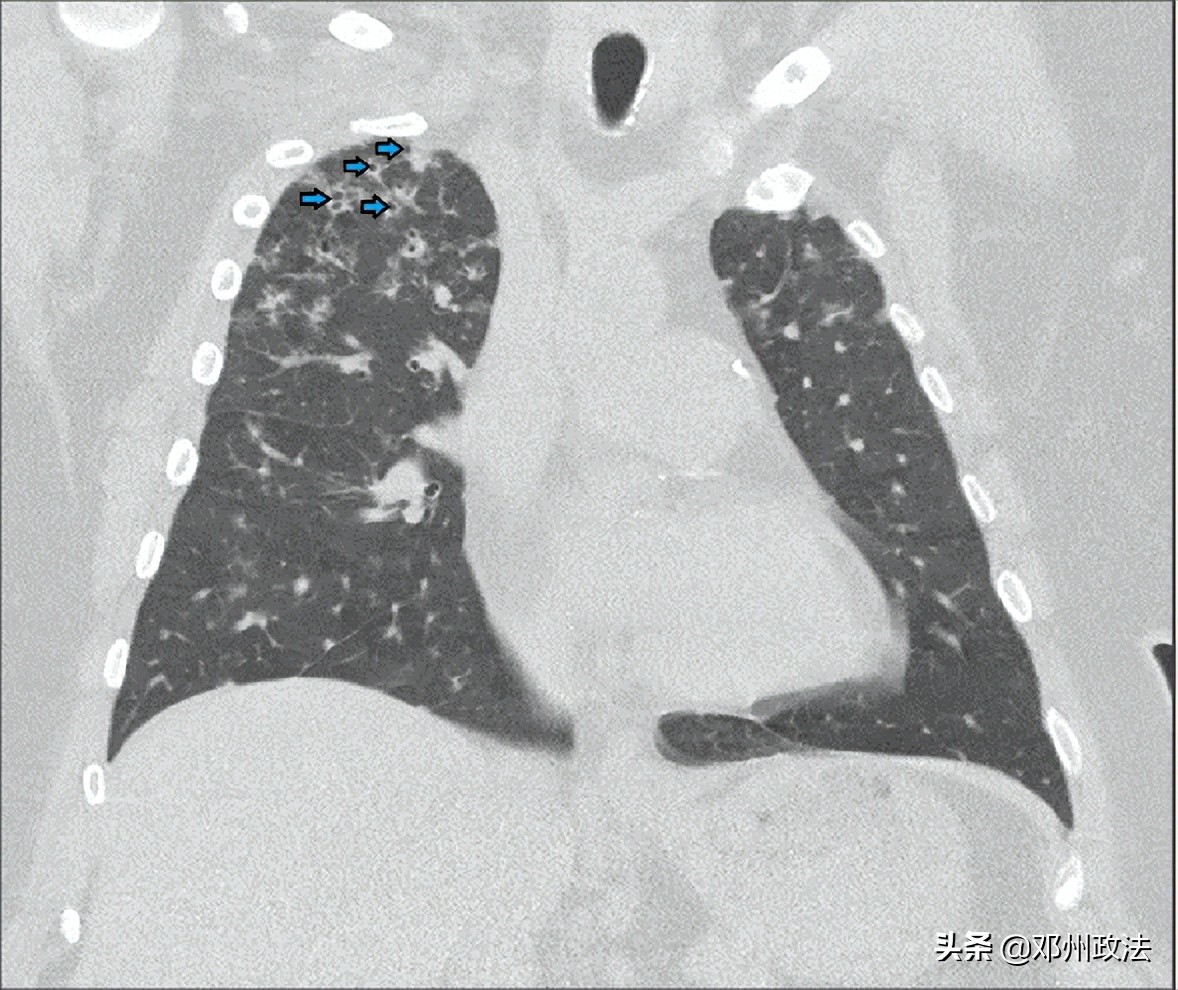 56岁大叔治病,老人肺炎用激素能治愈吗