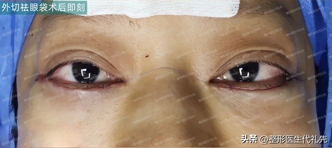 眼袋有明显的脂肪,眼袋脂肪去了显年轻