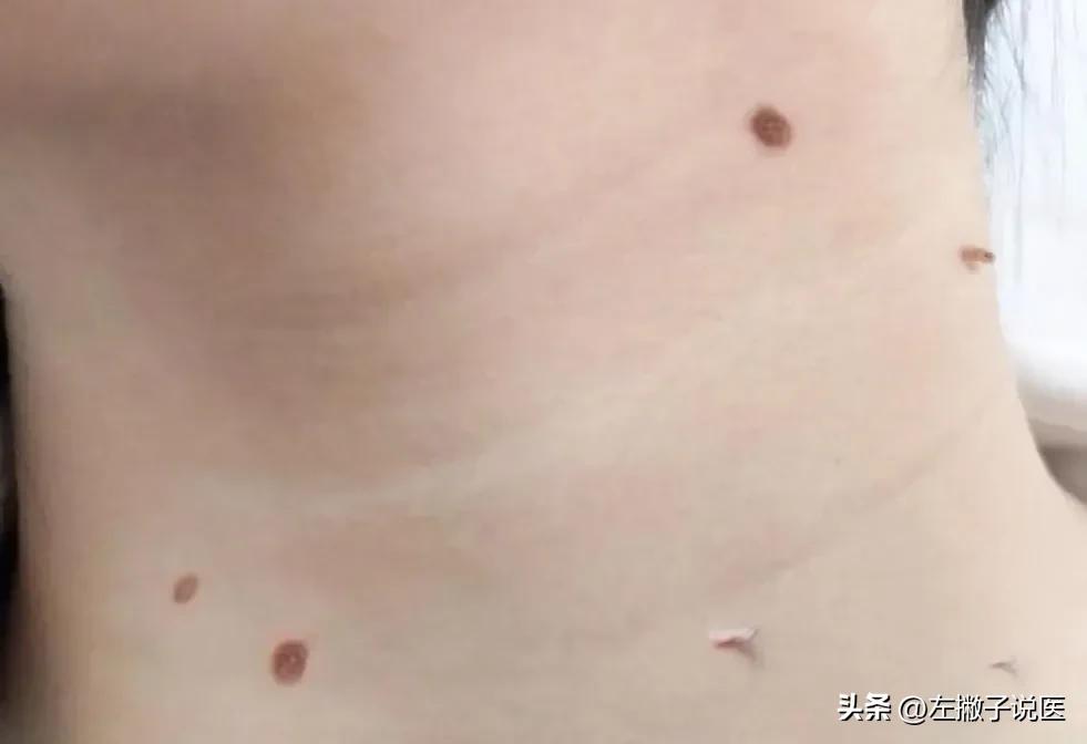 脖子上的“小肉球”是怎么一回事？可以用手抠掉吗？告诉你答案