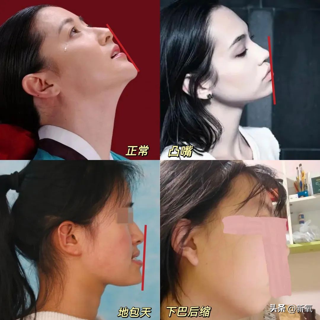 牙齿正畸和骨骼正畸的区别,牙齿正畸和眼轴增长有关系吗