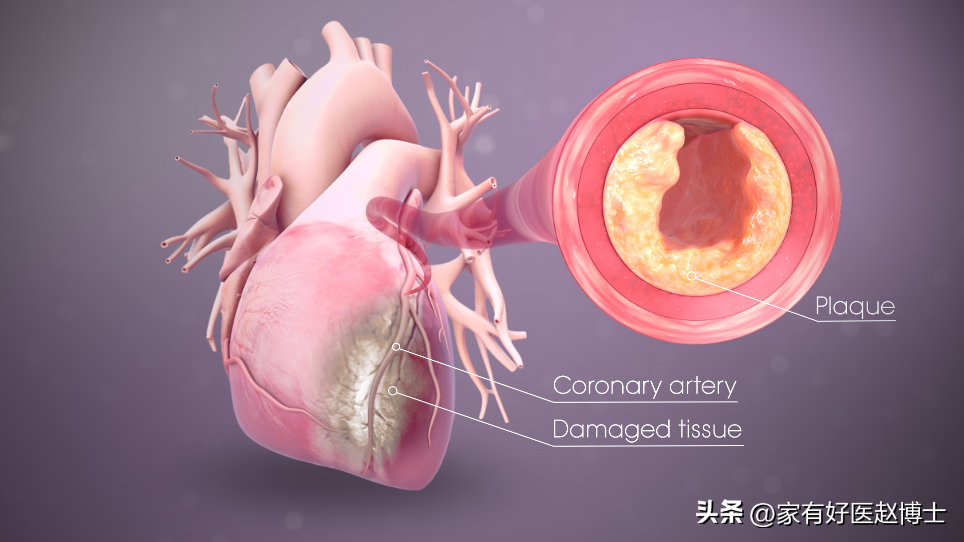 冠心病血压低不能离泵怎么办,冠心病患者低压低怎么办