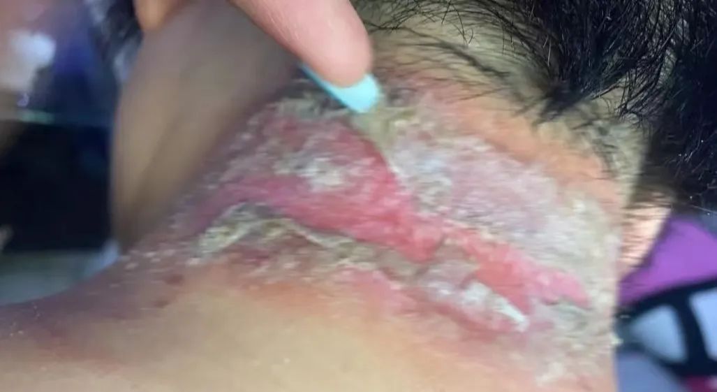 夏季常见蚊虫叮咬图鉴,女孩被家人吸血10年