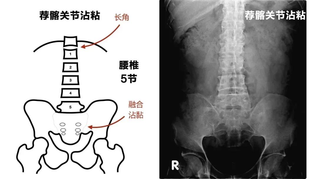 济南强直性脊柱炎脚后跟疼,强直性脊柱炎引起脚跟肿痛