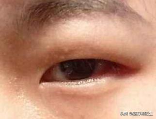 肿眼泡适合做埋线双眼皮吗,贴双眼皮贴还是肿眼泡可以埋线吗